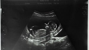 В Шотландии снова наблюдается рекордно высокий уровень абортов