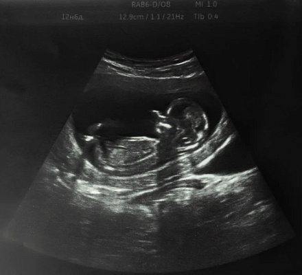 Las leyes provida no provocan un aumento de la mortalidad infantil, según un experto en obstetricia y ginecología